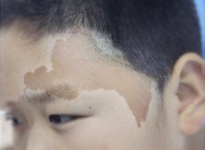 新生儿手上有青色胎记,新生儿易长的六种胎记