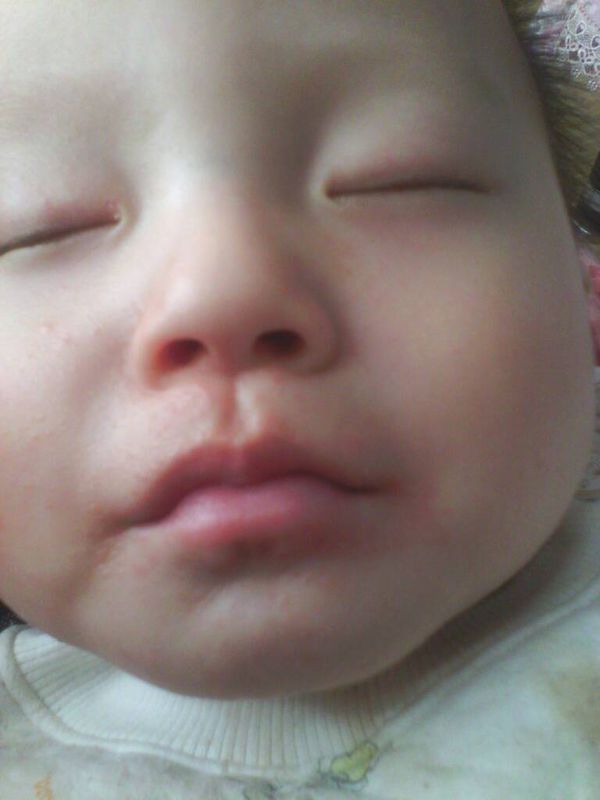 宝宝嘴周围有小红疹子嘴唇有点肿,宝宝嘴周边长小红疙瘩是上火吗