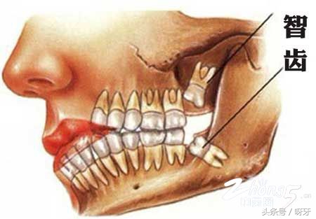 长出来的智齿真的有必要拔吗,智齿已经长出来了拔除难度大吗