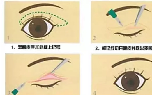 和阿姨的双眼皮做的太宽失败了