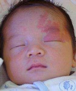 新生儿手上有青色胎记,新生儿易长的六种胎记