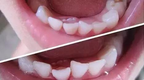 孩子牙齿畸形怎么办,小孩子牙畸形怎么办