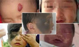 新生儿手上有青色胎记,新生儿易长的六种胎记