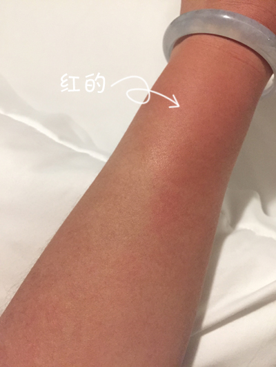 去海边晒伤了怎么办怎么修复,海边游玩晒伤之后怎么处理