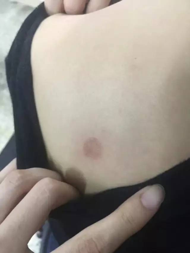 人传染了猫癣还会传染给其他人吗,得了猫癣会烂哪里