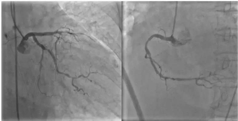 突发胸闷气短呼吸困难2小时,晚上突然胸闷睡不着要不要去医院