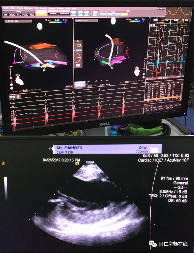 射频消融的仪器,射频心脏消融术