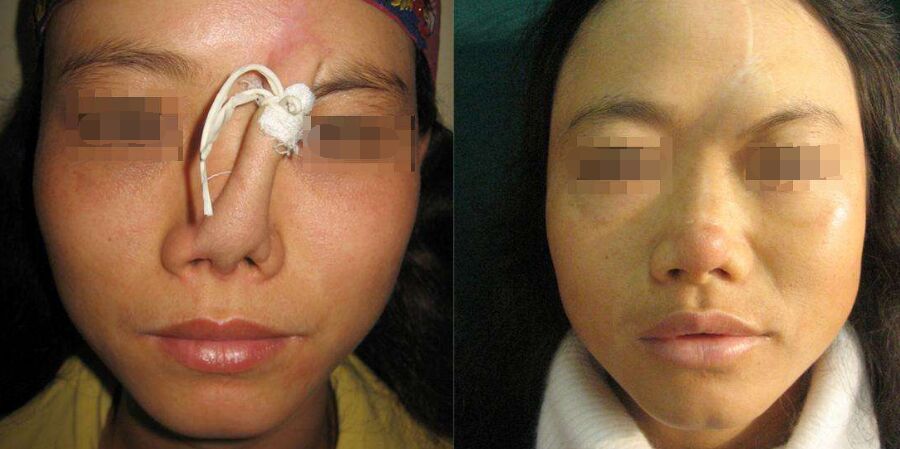 歪鼻子去哪里矫正,歪鼻子应该怎么办呢