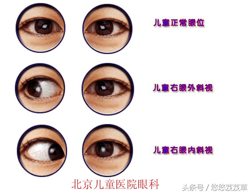 怎么判断自己有没有斜视自测,儿童斜视医院怎么检测