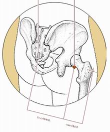 针灸治疗痹症的穴位,痹症的中医针灸治法