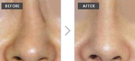 歪鼻子去哪里矫正,歪鼻子应该怎么办呢