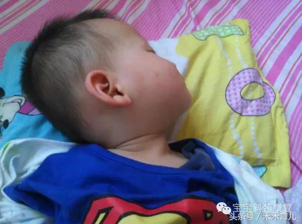 粗心妈妈使孩子胳膊脱位,斜颈宝宝歪头