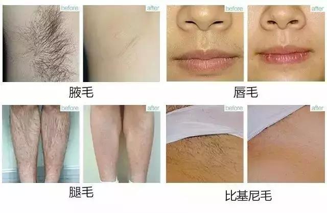 脱毛不谨慎刮掉一层皮怎么办,脱毛不谨慎刮伤补救