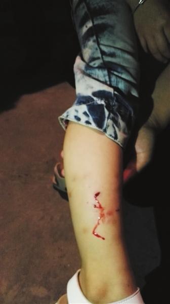 男子被自己养的狗咬到脚了去医院,男子被自己养的宠物狗咬了