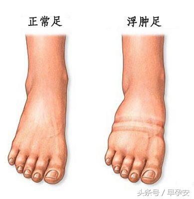 孕期脚肿怎么消肿最好最快,孕期水肿腿如何消肿图片