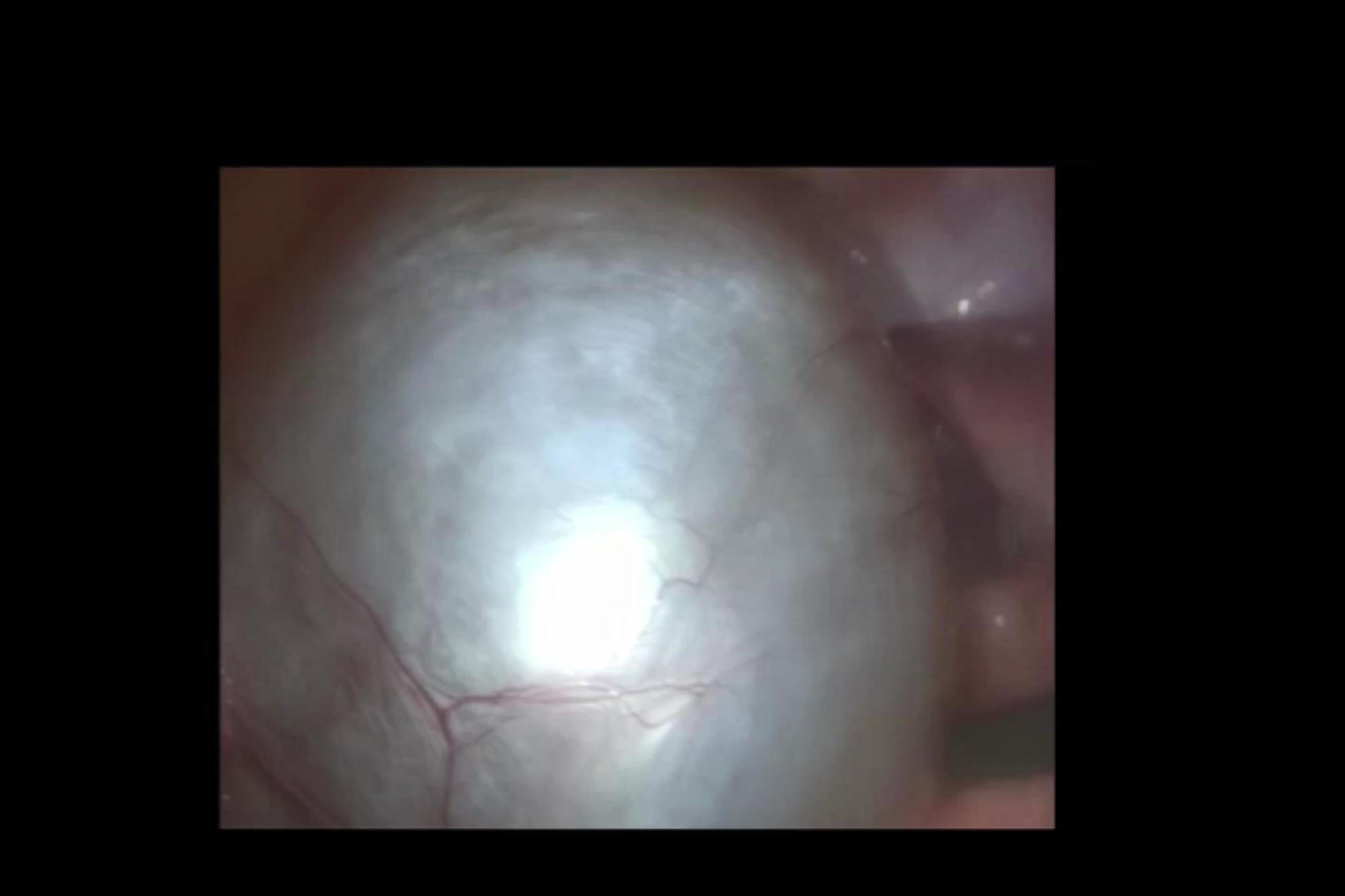 卵巢囊肿蒂扭转可以吃药不,卵巢囊肿50mmx38mm吃药能消吗