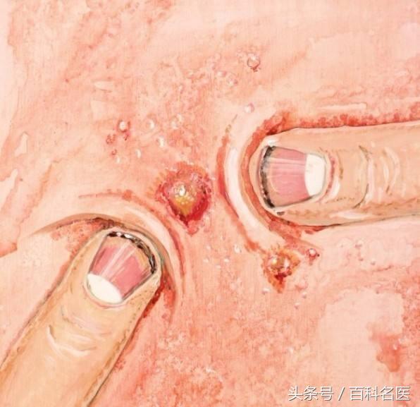 抗痘技巧,多年的痘痘肌怎么抗痘