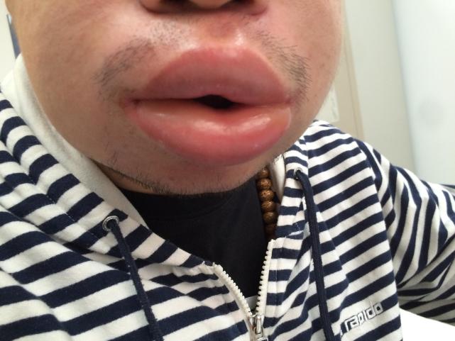 为什么嘴唇一夜之间会肿成香肠嘴,嘴唇起麻疹怎么办