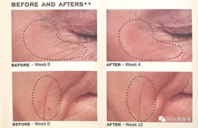 提拉紧致抗衰老美肤仪,提拉紧致美容仪效果最好的