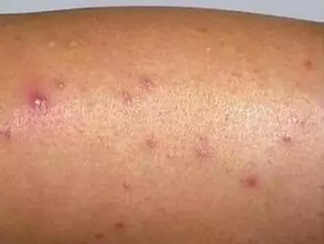 脱毛不谨慎刮掉一层皮怎么办,脱毛不谨慎刮伤补救