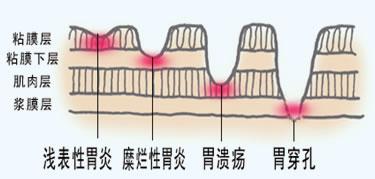 早餐吃不好最易得胆汁反流性胃炎，该怎么办？