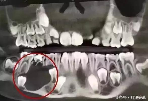 小孩子牙齿全部烂光,五岁男孩牙齿全烂了