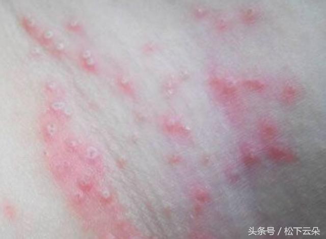 用西瓜皮怎么治痱子,西瓜皮治痱子方法