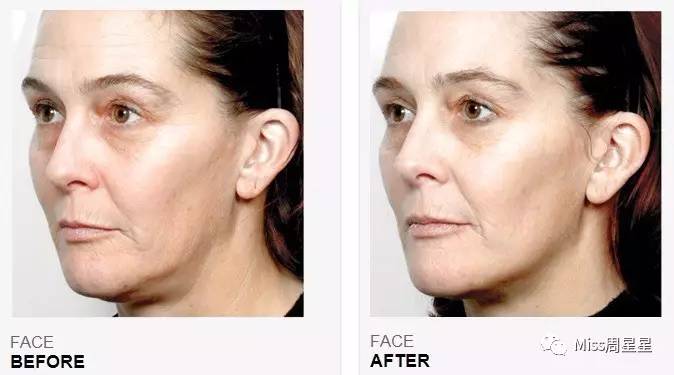 美容仪newa与雅萌ace区别,美容仪newface