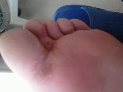 脚板磨出水泡还能继续打球吗,打球磨出水泡怎样处理