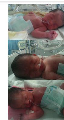 孕31周羊水早破的宝妈,三胞胎孕妇怀孕33周羊水破了