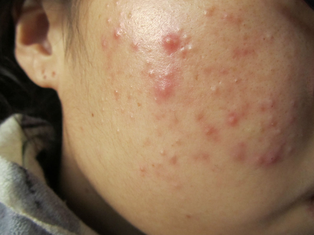 有疮要关注什么,皮肤长疮的最快的治疗方法