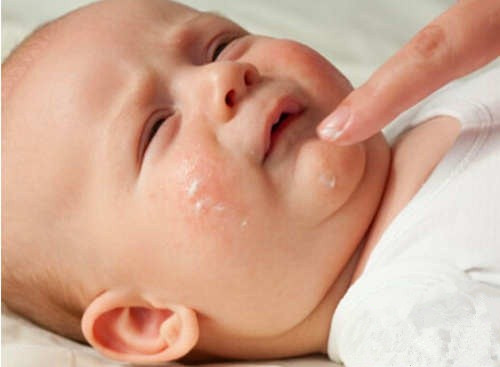 小孩脸湿疹皮肤损伤怎么修复,小婴儿皮肤湿疹