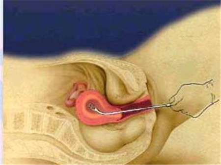 葡萄胎怎么检查出来呢,葡萄胎再次怀孕要不要检查卵子