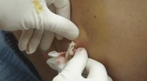 扰人的痘痘问题，你都可以解决！