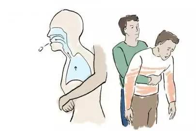 气道里有异物怎样消除,气道有异物如何急救