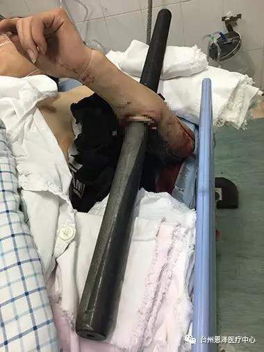 男子手臂被栏杆穿透消防救援,男子手被撞断惊险瞬间