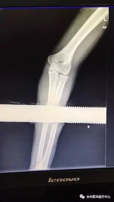 男子手臂被栏杆穿透消防救援,男子手被撞断惊险瞬间