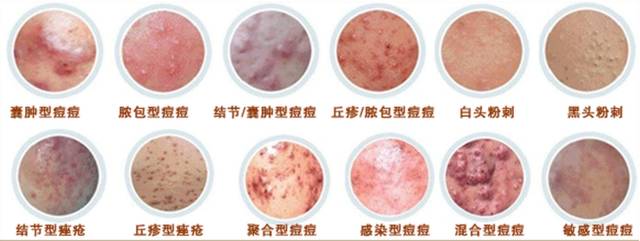 扰人的痘痘问题，你都可以解决！