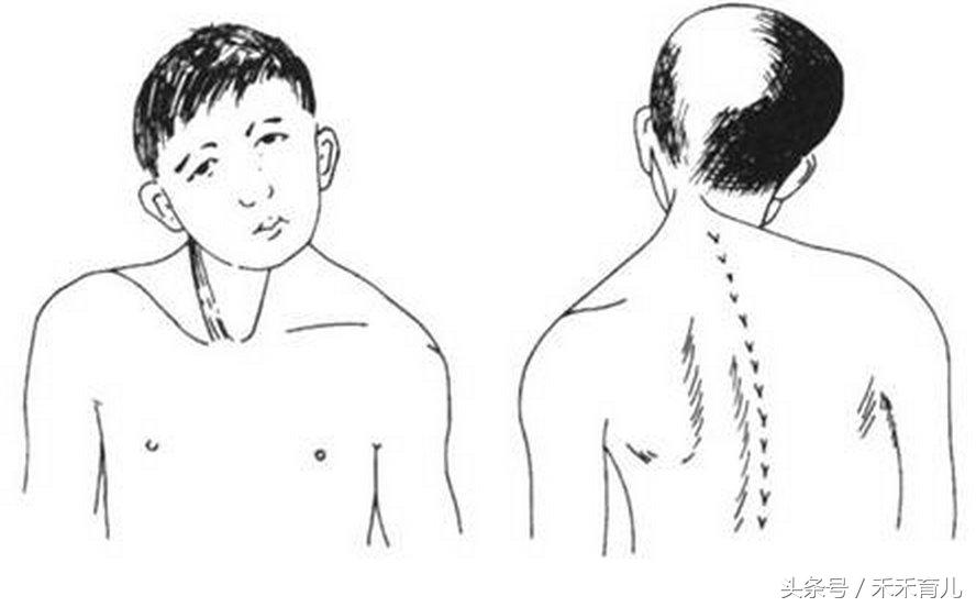 粗心妈妈使孩子胳膊脱位,斜颈宝宝歪头