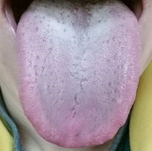 吃了治胃中药反而胃胀是什么原因,胃酸胃胀反酸水烧心服用什么中药