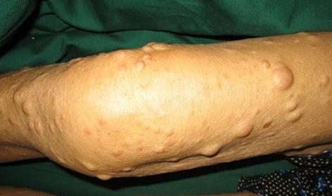 什么样的人最易得脂肪瘤,颈部脂肪瘤会致命吗