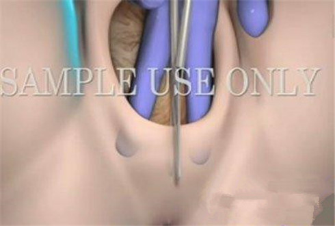 图片全程为你揭秘：产妇分娩侧切全过程