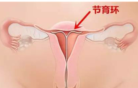 What?上环都能怀孕！千万别认为上了环就可以高枕无忧了