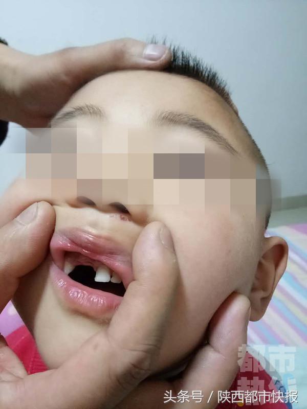 小朋友玩闹把孩子头磕了怎么解决,孩子玩闹磕坏门牙责任