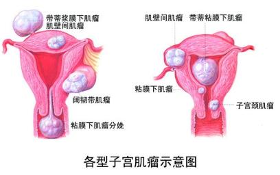 子宫上长了个包？别笑，三分之一的女性都会长！