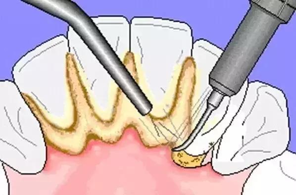 拥有一个好牙,拥有一口好的牙齿很重要