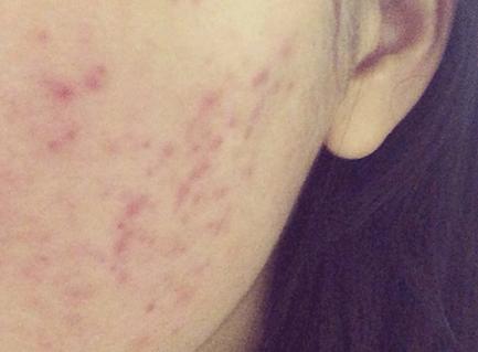 红色痘印怎么祛除,鼻子红色痘印怎么祛除