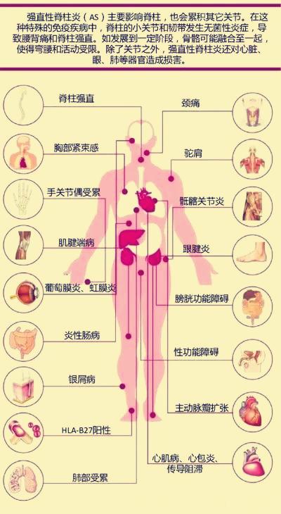 强直性脊柱炎虹膜炎阿达木单抗,强直性脊柱炎虹膜炎打生物制剂