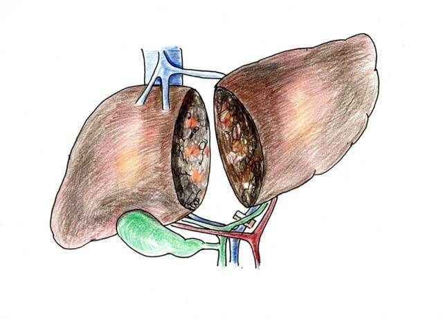 乙肝转阴正确方法,乙肝转阴三步骤