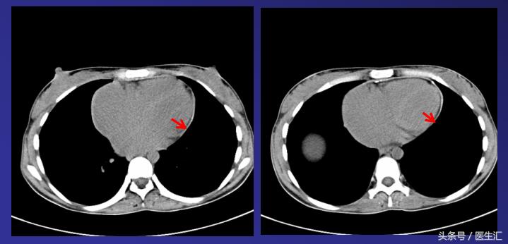 感染科可以治肝腹水吗,腹水被传染了怎么办
